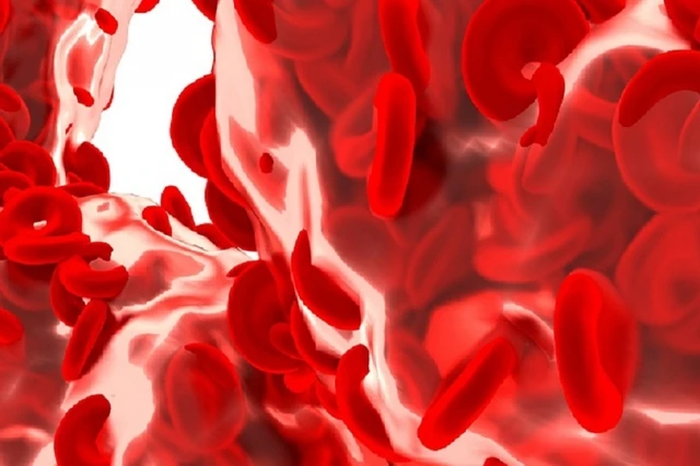 Anemia: cause, disturbi e rimedi contro la carenza di ferro